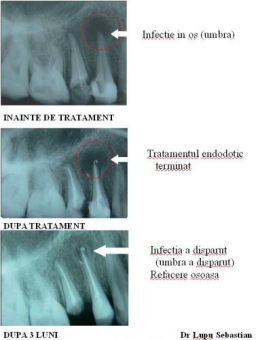 Ce este endodontia sub microscop?