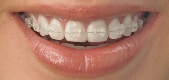 Aparate dentare