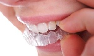 Bruxismul si tratamentul sau in stomatologie