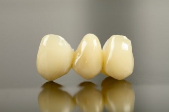 Coroana ceramica pe suport de zirconiu