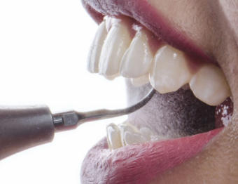 Detartrajul dentar