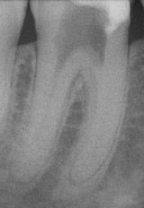 ENDODONTIE Tratamentul de canal
