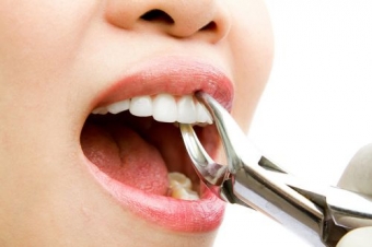Sfaturi de urmat dupa o extractie dentara
