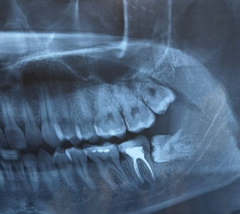 Molar de imnte care nu erupe, extractie