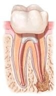 Retratamentul endodontic