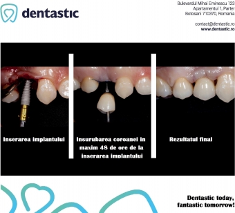 Implant dentar si restaurare dentara 