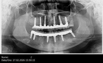 Implant-all-in-6-arcada-galati