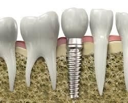 implanturi made in Israel