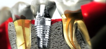 prelungirea duratei de viata a implantului dentar