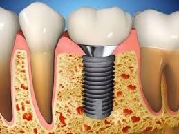 Implant dentar Timisoara, Dr. Cristina Mihai