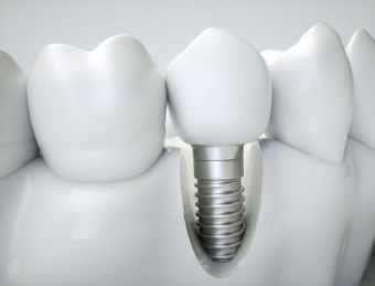 Puntea dentara sau implant