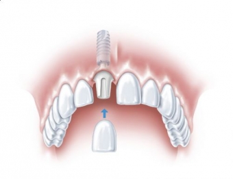 recomandari implant dentar