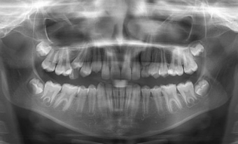 Teama de radiografii si iradiere: mit sau realitate?