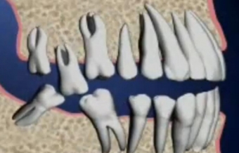 Migrarea dintilor dupa extractia dentara