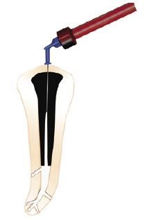 Avantajele Sistemului de Endodontie Ultradent
