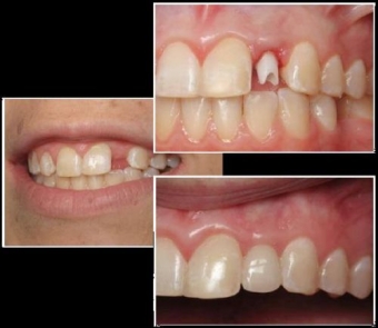 implantul dentar o necesitate