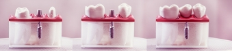 inserarea unui implant dentar