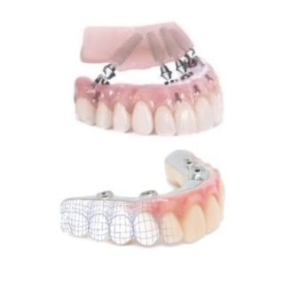 Refacere dantura prin implant