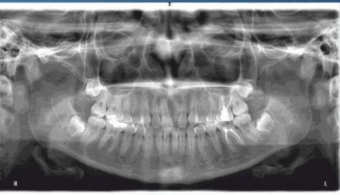 Ce trebuie sa stim despre CBCT?