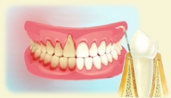 retractie gingivala