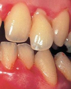 Sangerarea gingivala