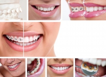 Aparat dentar - ortodontia