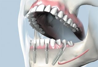 extractie implantare si restaurare implant dentar