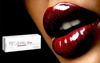 Marire buze cu TEOSYAL Kiss