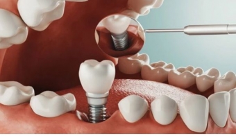 Tipuri de implanturi dentare,ce aleg