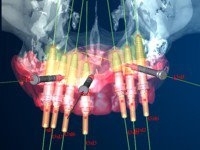 Imagine 7 martie Curs ARDS Implants - Computer tomograf-CBCT si ghid chirurgical pentru implantologie