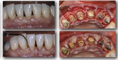 Imagine Curs de Parodontologie Clinica, Prof.Francis Louise,1-2 iunie Tragu Mures
