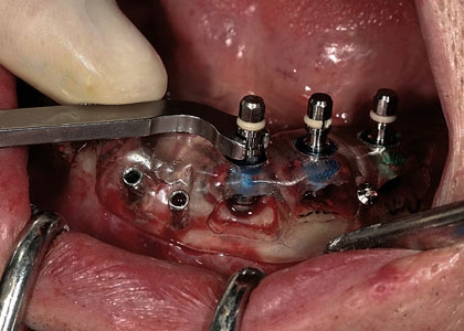 Imagine  CBCT si ghid chirurgical in implantologie