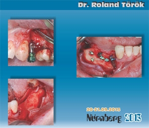 Imagine Managementul tesuturilor moi si dure periimplantare