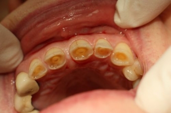 Eroziunea dentara de cauza medicamentoasa