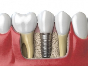 Etapele realizari unui implant dentar