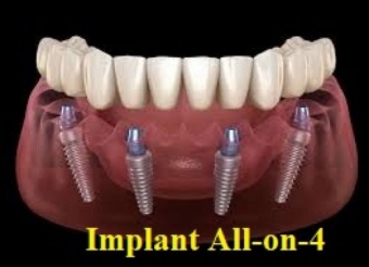 Implant all on 4 implant-arcada