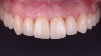 Despre protetica dentara,Unique Smile