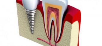 avantaje si dezavantaje ale implantului dentar
