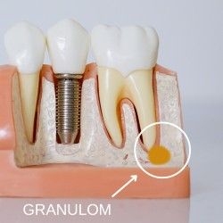 Chisturi dentare sau rezectii granuloame  Chistul dentar si indepartarea acestuia