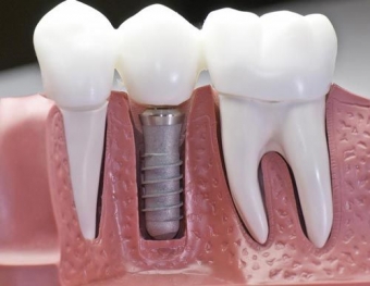 Inlocuire implant dentar dinte lipsa