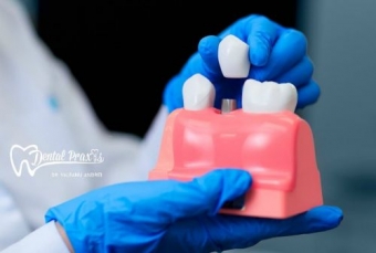 Avantaje implant dentar