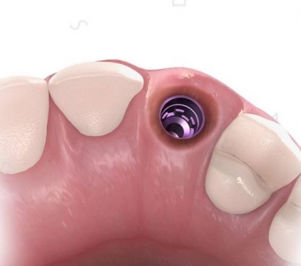 Imagine Oferta implant dentar Sector4