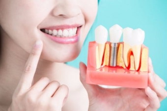 Implantul-dentar-dinti-lipsa