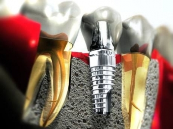tratament de electie implant dentar
