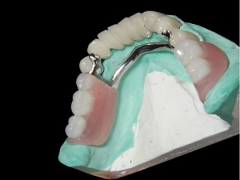 implant dentar accesibil tuturor