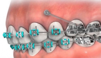 Miniimplanturile ortodontice Tratamente ortdontice, miniimplanturi