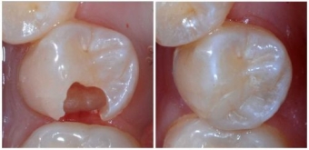 Imagine Reducere sigilare dentara copii + plombe 